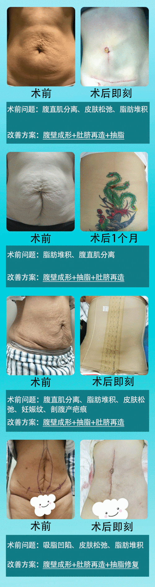 腹壁成形解决产后疤痕妊娠纹过度减肥严重松弛下垂问题腹壁整形重返s