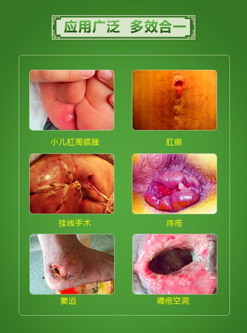 肛周脓肿肛瘘拔毒膏成人外用拔脓瘘管窦道清理内外口