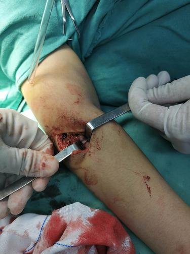 桡骨小头骨折 弹性髓内钉