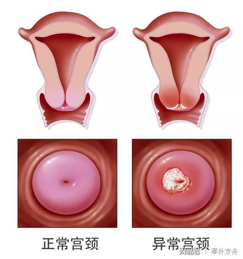 为什么越来越多的年轻女性患宫颈癌,跟这个有关!