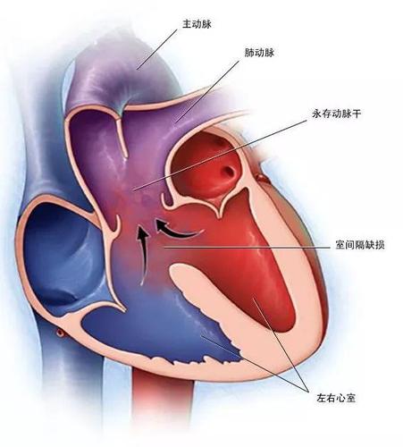 图20 永存动脉干合并室间隔缺损(图中红色代表富氧血,蓝色代表乏氧血