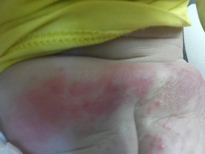 家里八个月女婴屁股上面有块红肿.不知道是什么病?应该应该怎么办?