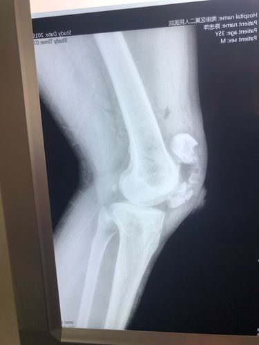 外科完成一例髌骨粉碎性骨折内固定术