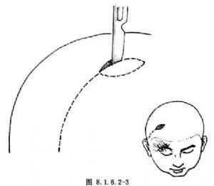 颞浅动脉顶支岛状皮瓣眉毛再造及上睑缺损修复术