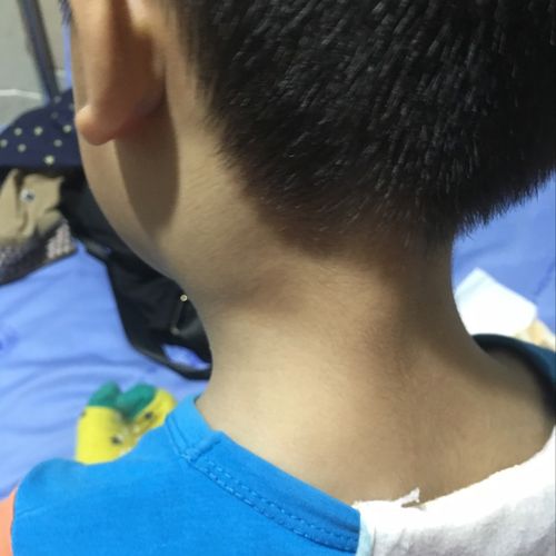 宝宝脖子耳朵下面肿了不痛 是这么回事啊