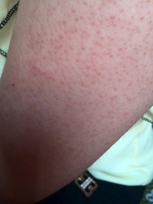 胳膊上好多好多小红点,很多年了,该怎么办?t^t