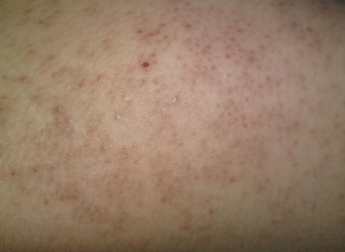 求:请问这是毛囊角质化还是毛囊炎?有图