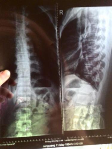 怎样形成胸腰段生理曲度存在的?