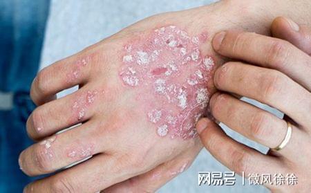 银屑病就是在皮肤上出现红斑,斑块上覆有鳞屑,鳞屑下可出现透明的薄膜