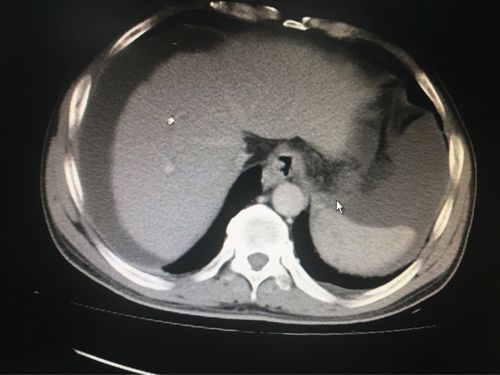 ct提示肝硬化,腹水,食管内可见扩张的血管