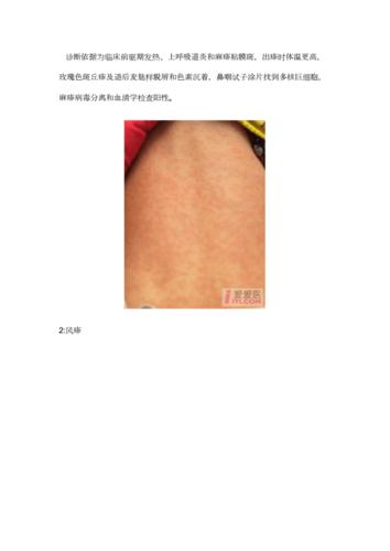 小儿各类皮肤病和图片.docx 12页