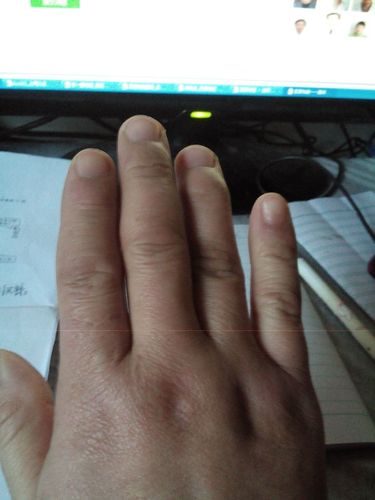 我的是右手中指与无名指,但中指  肿胀是腱鞘炎导致的吗?