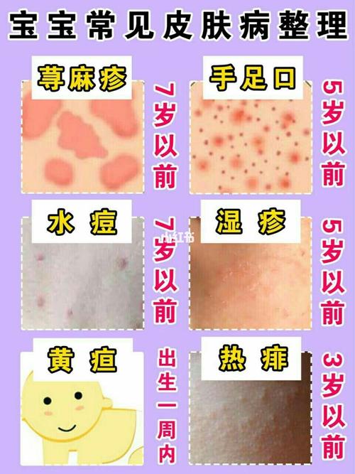 宝宝常见皮肤病整理_湿疹_皮肤病_爽身粉_敏感肌_夏天