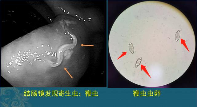 吃出来的大肠寄生虫,只因做错1件事,医生教您远离寄生虫