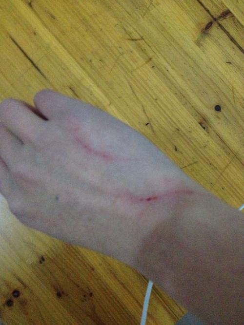 被兔子抓伤已经超过24小时了,还有必要做补救措施么?