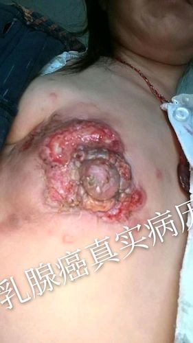 阜蒙艾乳腺癌调理真实案例