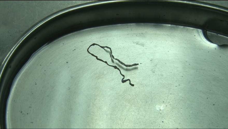 少女写字速度突然变慢 医生开颅取出一条寄生虫