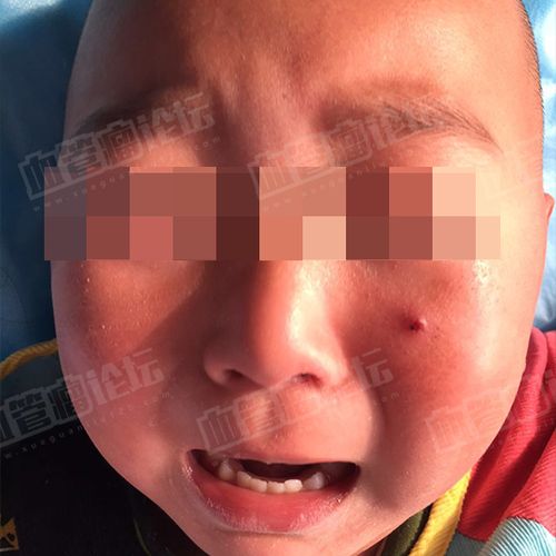 来自 江*恺-左侧面部-婴幼儿血管瘤 患者日记