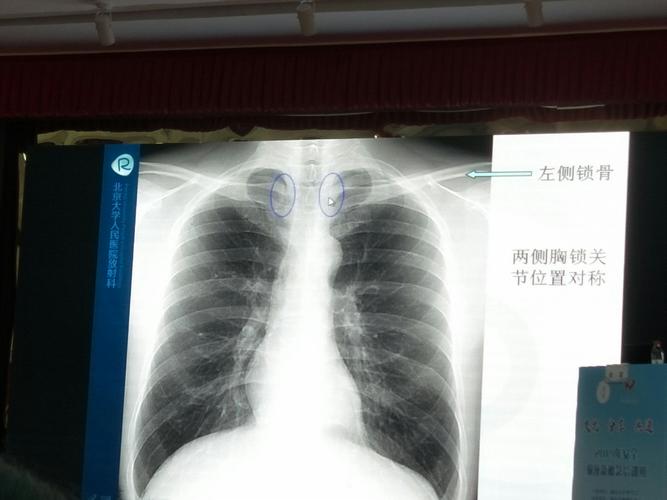 胸片及ct观察picc管