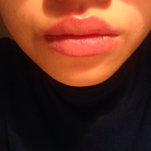 嘴唇肿大,上面有很多小小的粒粒,抿嘴唇会觉得有水湿湿的.怎样才能好?