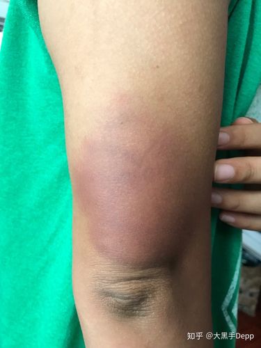 肿成猪脚的胳膊肘