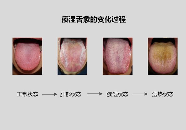 乔妹的舌象刚好介于痰湿和湿热之间,理气化痰正当时.