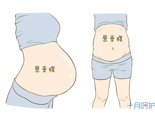 孕妈身材三杀手:悬垂腹,静脉曲张,妊娠纹