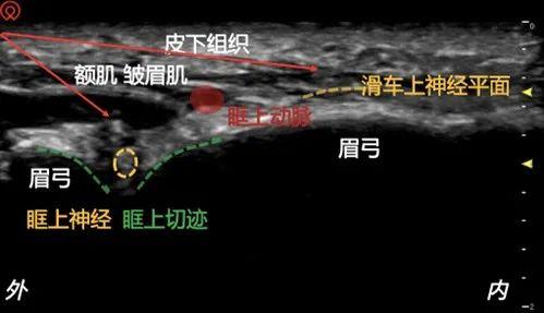 图3 眶上神经阻滞和滑车上神经阻滞超声图像及眶上动脉多普勒图像