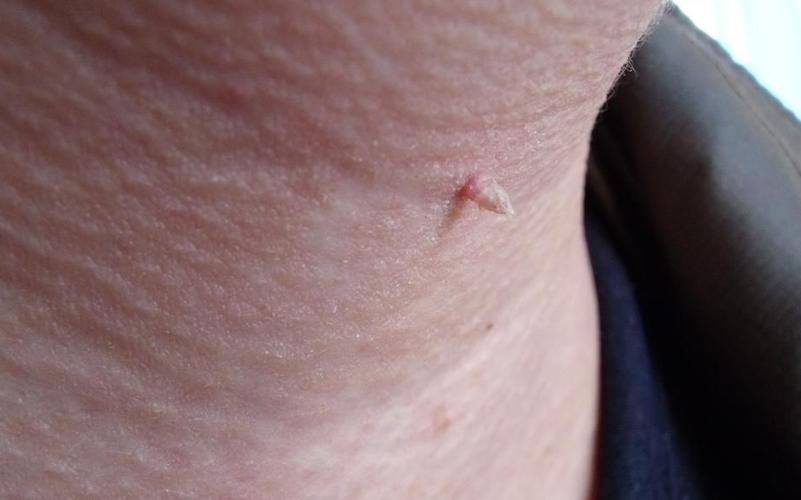 千万要注意,初期hpv感染就会形成这种红点,但时间久了红点,丘疹,就会