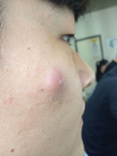 脸上长了一个大包,请问这是什么症状,怎么解决,详细点