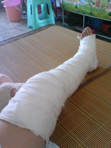 去医院拍了x片,结果是骨裂,从小腿的骨头一直到脚踝,已经打上石膏了