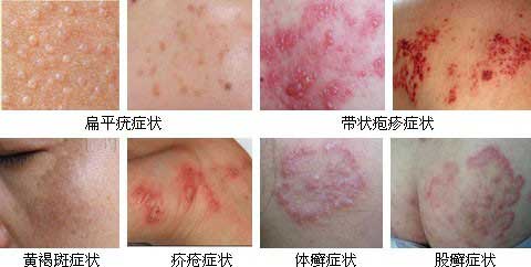常见皮肤病的种类及症状图片