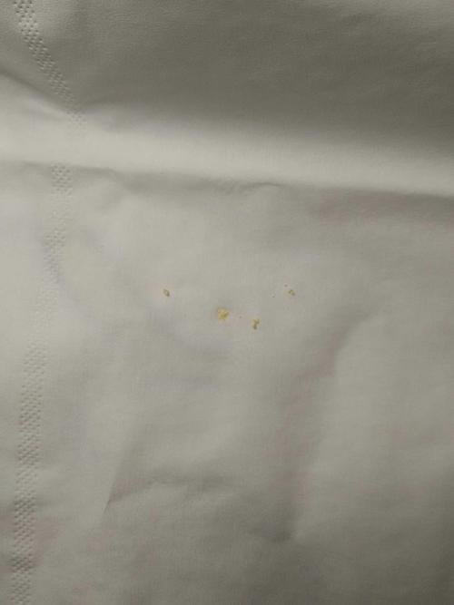 宝宝尿道口有白色颗粒状的东西