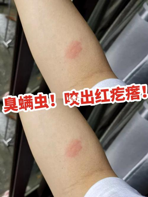 我被螨虫叮咬成这样!除螨喷雾真的有用吗?