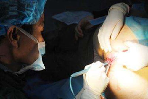 女性痔疮手术视频_有来医生