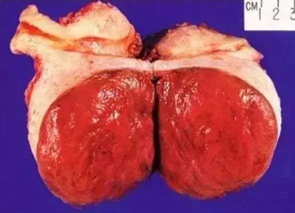 孕期肌瘤红色变性