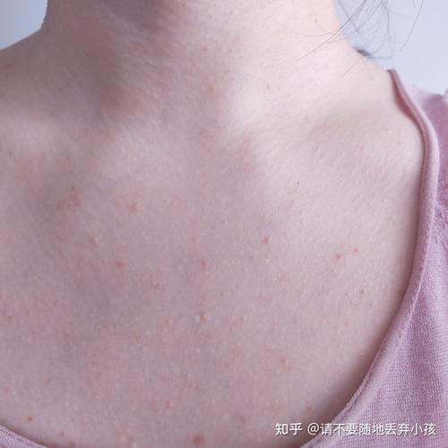 胸前的小疙瘩,不痛不痒,但是很难看,到底是怎么回事呢