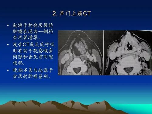 喉癌的ctmri诊断影像天地