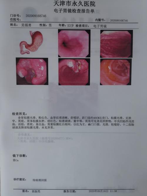 外一38床 吴** 胃癌患者病情介绍