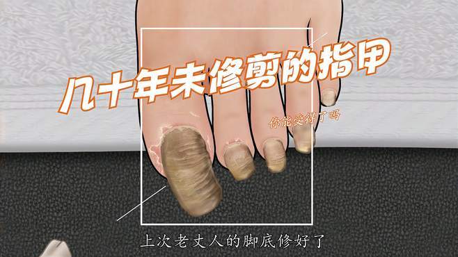 弯曲的脚趾甲,几十年未修剪过,你能受得了吗