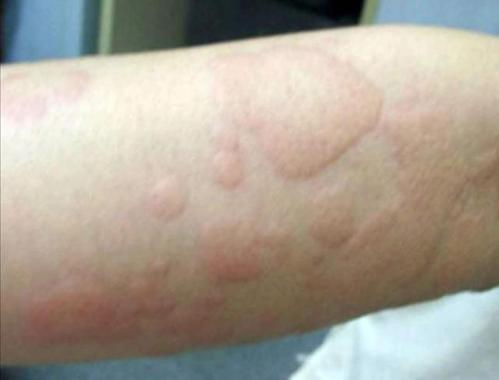 关注儿童过敏性皮肤病