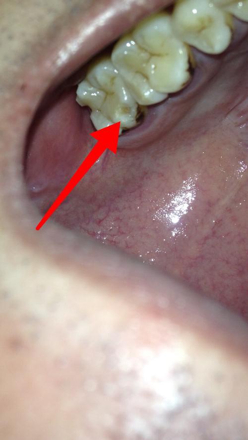 这牙齿缺了一块,是蛀牙吗?被牙虫吃掉的吗?这种算严重