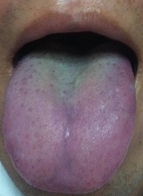 懂中医的朋友看看这个舌苔表示什么健康问题?刚拍的.谢谢.