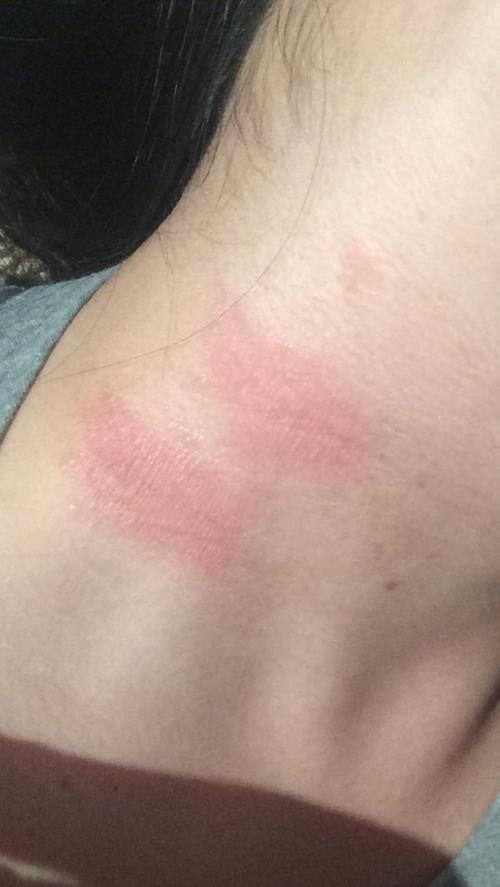 脖子这里的红斑已经两周多了,一开始痒得要命,然后我就不停地挠,现在