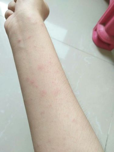 胳膊上起了红疹子