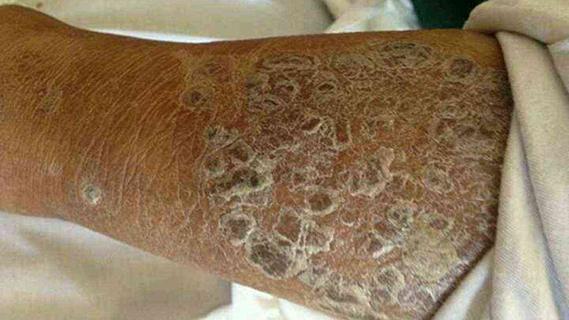 糙皮病的诊断及鉴别诊断