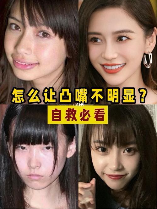 如何改善凸嘴71 牙齿矫正篇_凸嘴_牙齿矫正_丰乐广场攻略_美妆_医美