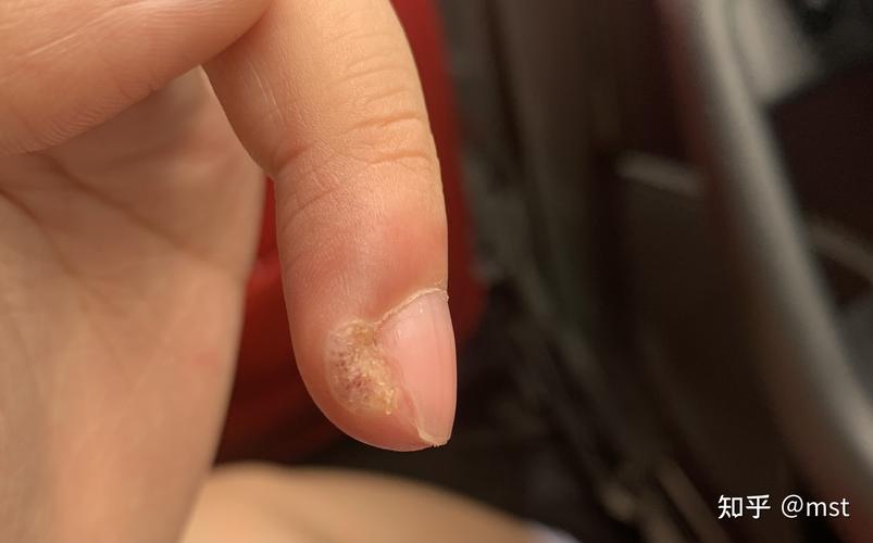 抗战甲周疣正式开始