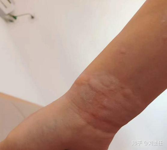 看看你是什么样的寻麻疹吧