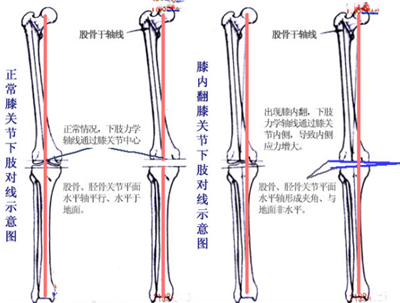膝关节骨性关节炎的"前世今生"